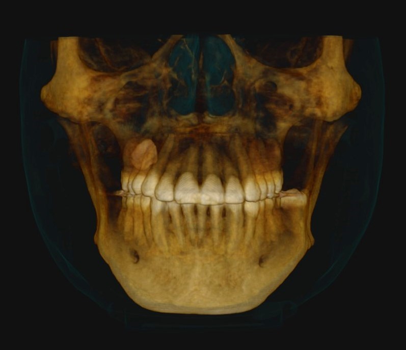 tomografia dental 3d