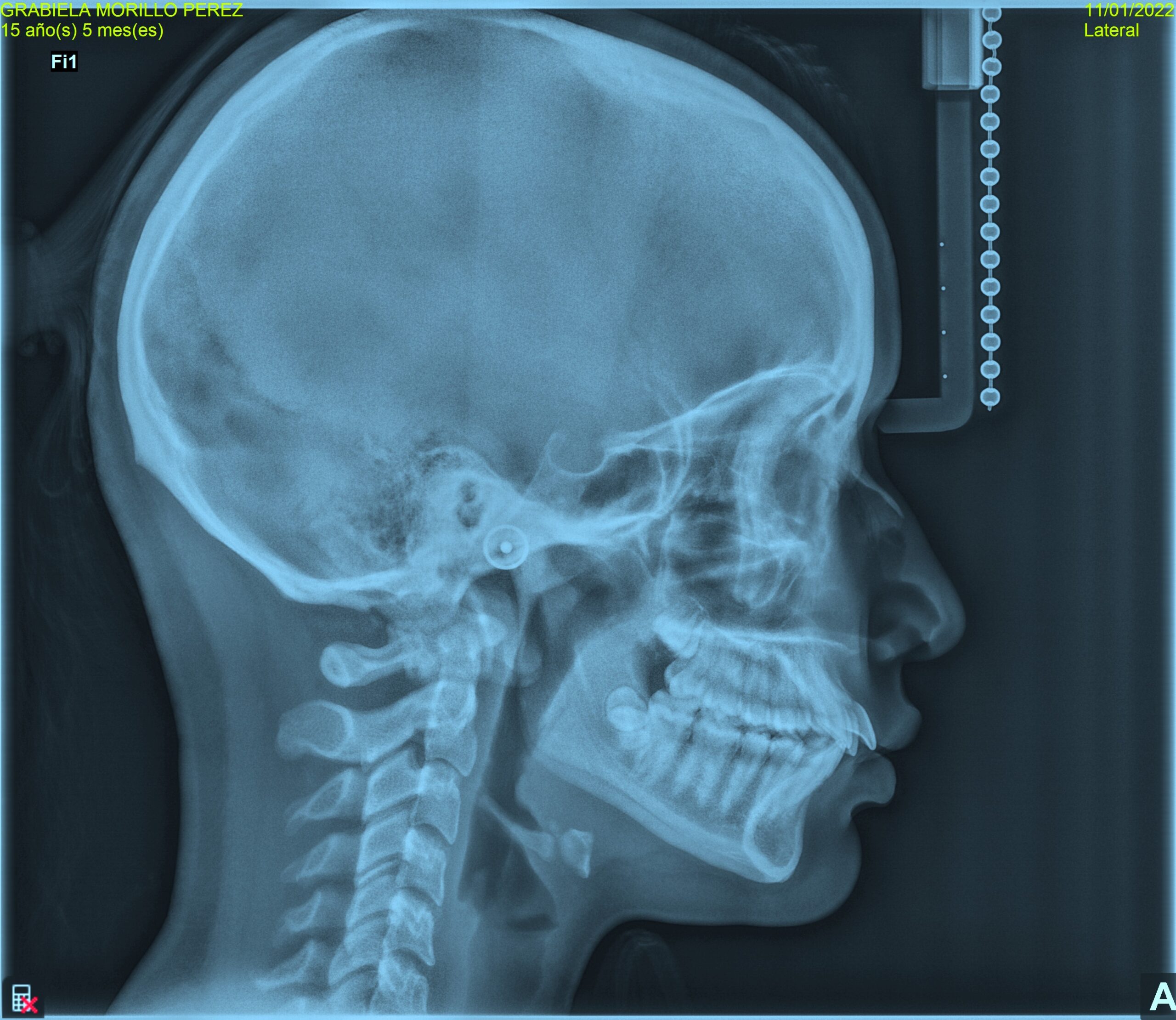 radiografia cefalometrica lateral